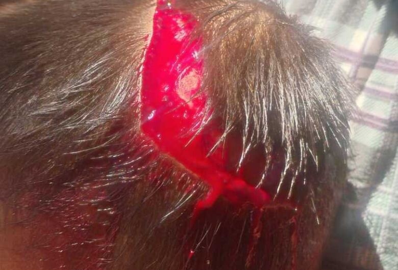 Mãe embriagada é suspeita de agredir criança de 2 anos em Dourados